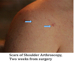Shoulder arthroscopy Bangalore,Shoulder specialist in Bangalore