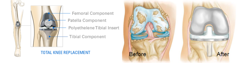 Best Knee Replacement Surgery in Bangalore: Expert Care