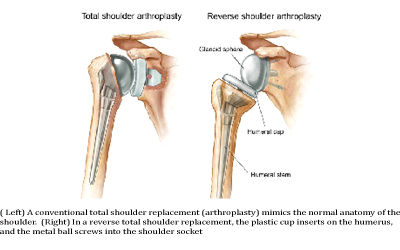 shoulder replacement surgeon in bangalore